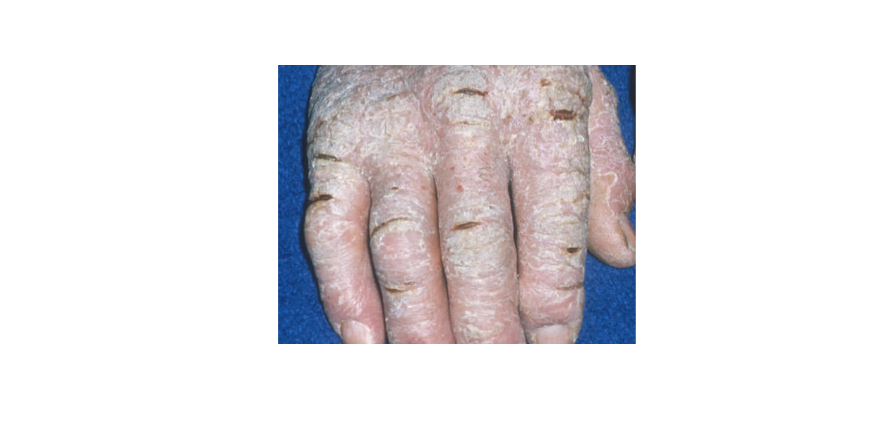 Eczema cronico delle mani